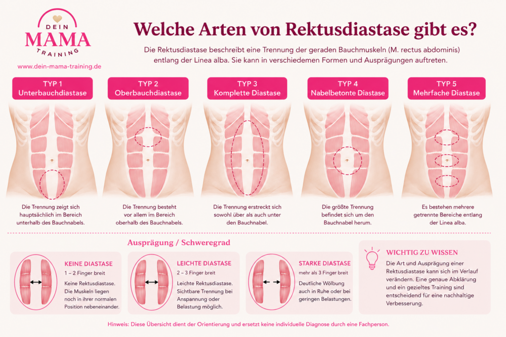 rektusdiastase verstehen 
